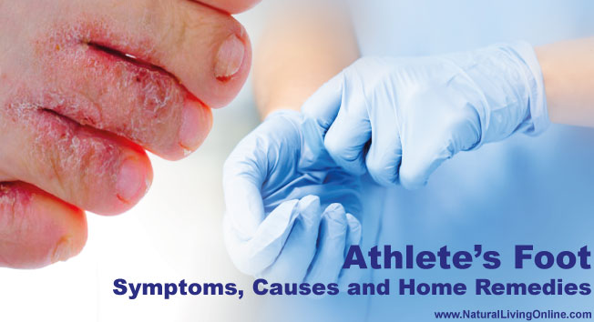 Athlete’s Foot Causes, Prevention and Home Remedies
