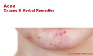 Acne and Herbal Remedies