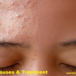 Acne Types, Causes and Treatment
