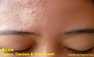 Acne Types Causes and Treatments