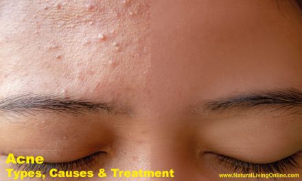 Acne Types, Causes and Treatment