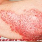 Eczema, Causes, Symptoms, Prevention, and Treatment