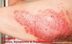 Eczema, Causes, Symptoms, Prevention, and Treatment