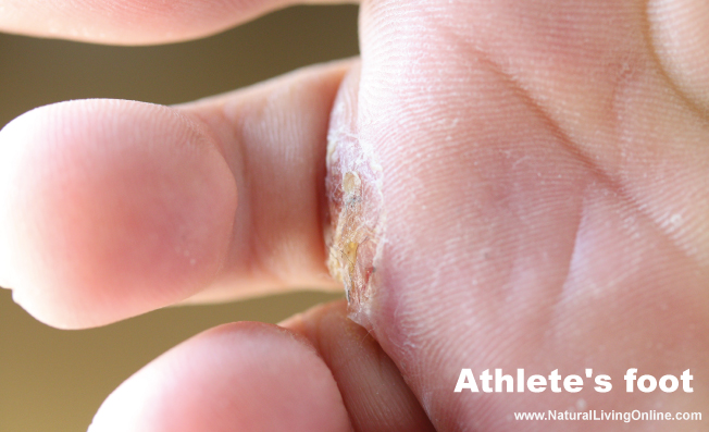 Foot Soak for Athlete's Foot