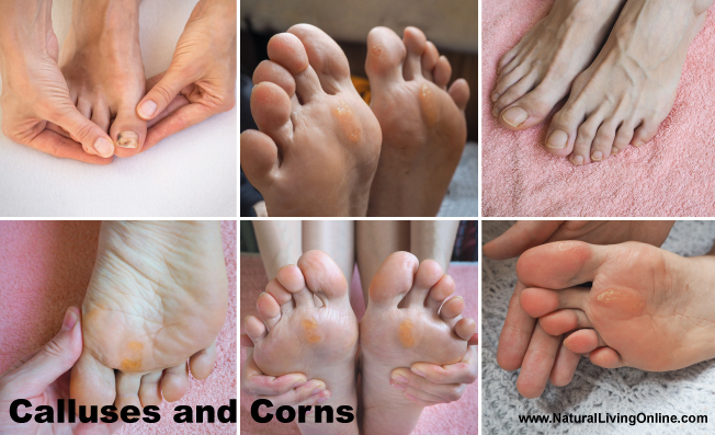 Foot Soak for Calluses and Corns