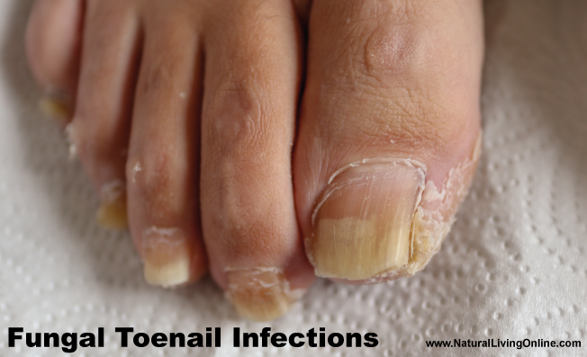 Foot Soak for Fungal Toenail Infections