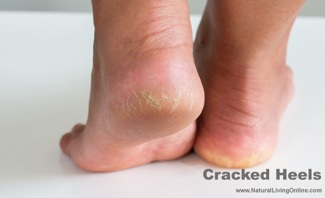 Foot Soak for Cracked Heels
