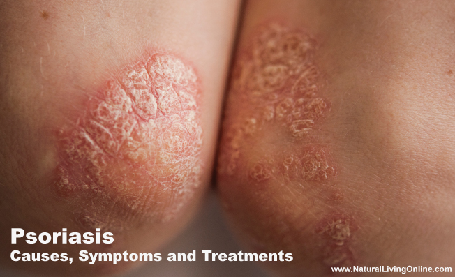 Psoriasis Causes, Symptoms and Treatments