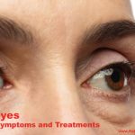Puffy eyes Causes, Symptoms and Treatment