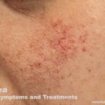 Rosacea Causes, Symptoms and Treatment