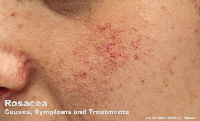 Rosacea Causes, Symptoms and Treatment