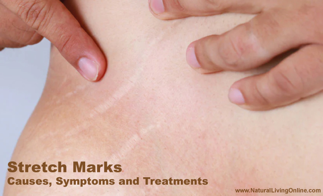 Stretch Marks Causes, Symptoms and Treatment