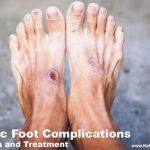 Diabetic Foot Complications, Symptoms, Prevention and Treatment