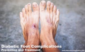 Diabetic foot complications