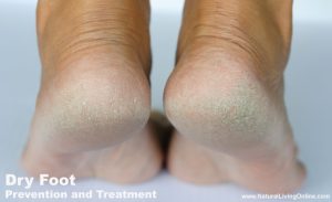 Dry Foot Care Prevention and Treatment