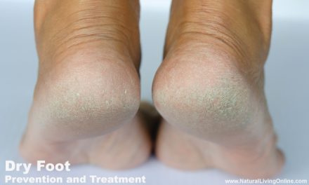 Dry Feet Types, Causes, Symptoms and Treatment