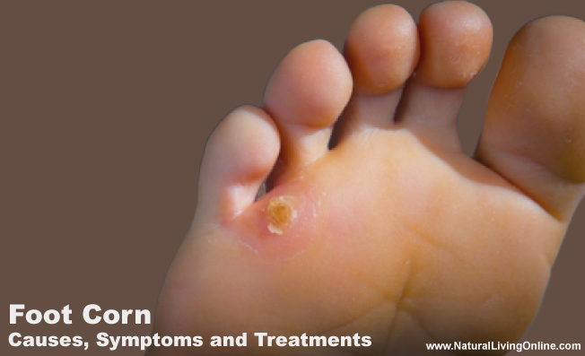 Foot Corn Causes and Treatment