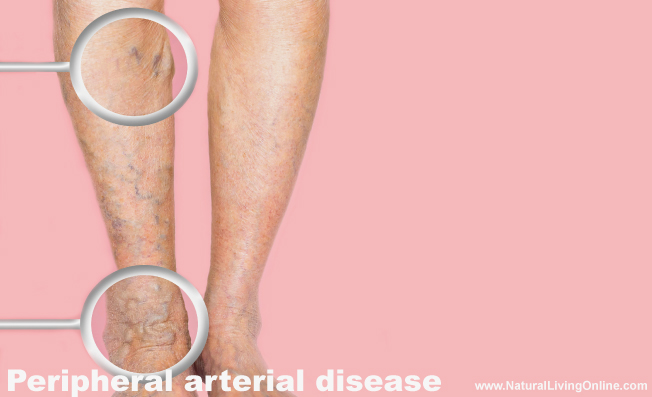 Peripheral arterial disease (PAD)