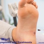 Plantar Wart Causes, Symptoms and Treatment